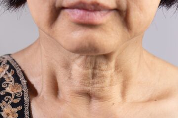Tratamientos no invasivos para la flacidez facial